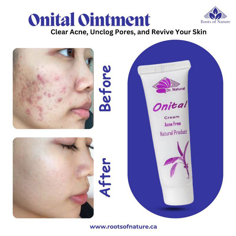 Onital – Organic Ointment for Acne Scars & Pimples