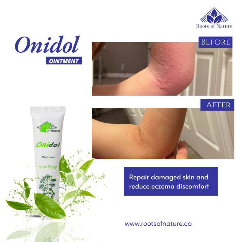 Onidol – The Natural & Safe Solution for Eczema Relief